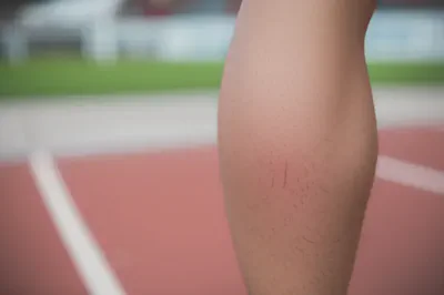 마라톤 후 근육 피로와 통증을 겪는 다리 근육의 모습
