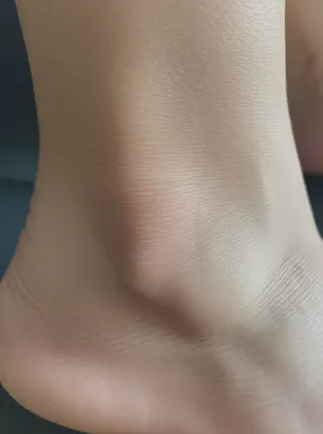 혈액순환 문제로 인한 부종의 흔한 모습