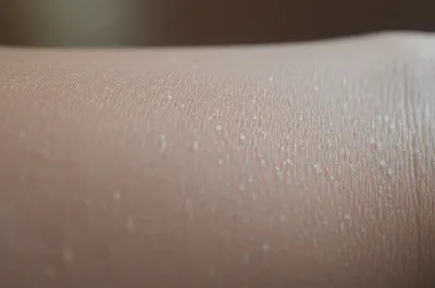 피부 수분 손실과 건조함의 시각적 표현