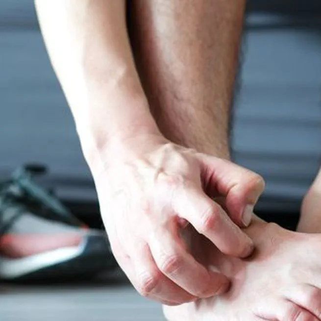 [건강물음표] 여름철 심해지는 '무좀', 어떻게 관리할까?