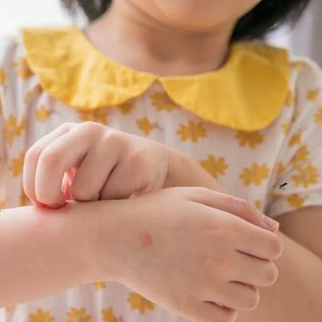 극심한 가려움에 진물까지... 아토피 피부, 모기 물림에 취약한 이유