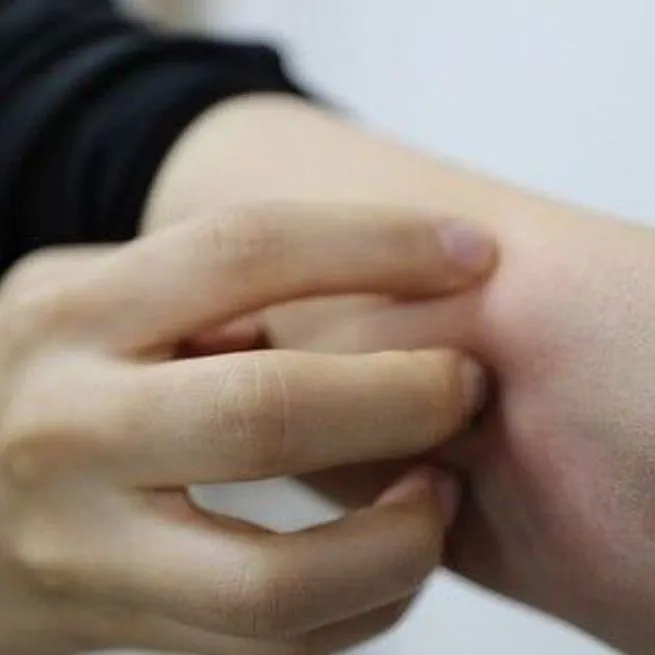 아토피피부염 완화 면역치료…효과 키우는 세포는 '이것'