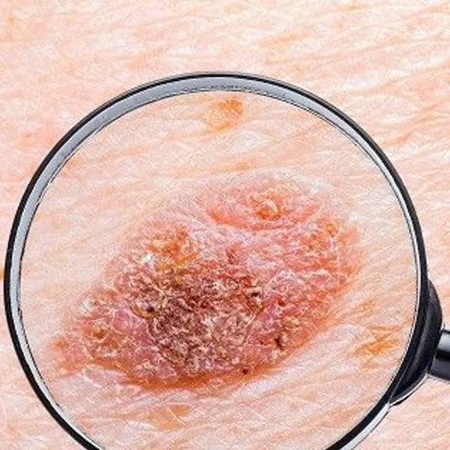 자외선 때문에 생기는 피부암, 피부질환과 구분하는 법